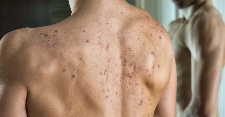 How to Treat Steroid Acne? – Some Crucial Steps
